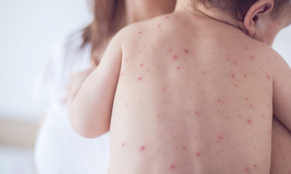 Dấu hiệu giảm tiểu cầu khi bị sốt xuất huyết không thể xem thường