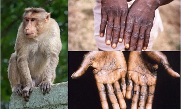 Không chủ quan với bệnh đậu mùa khỉ