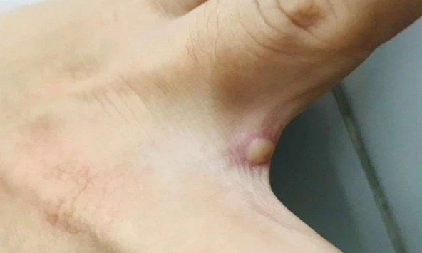 Đã có kết quả giải mã gene ca đậu mùa khỉ nội địa đầu tiên ở TP.HCM