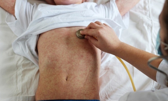 Bệnh sởi nguy cơ bùng phát, Bộ Y tế chỉ đạo khẩn