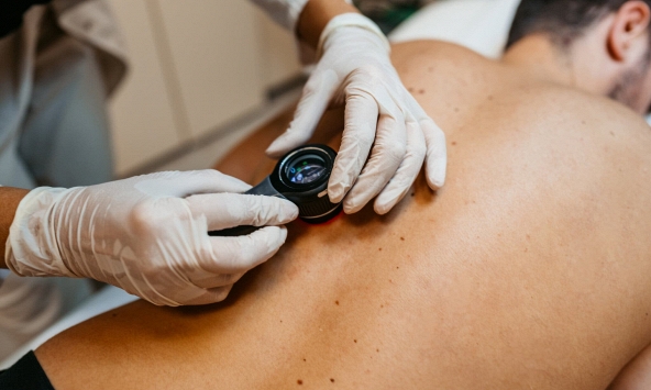 Đây là một trong những dạng ung thư da nguy hiểm nhất, làm thế nào để tránh?