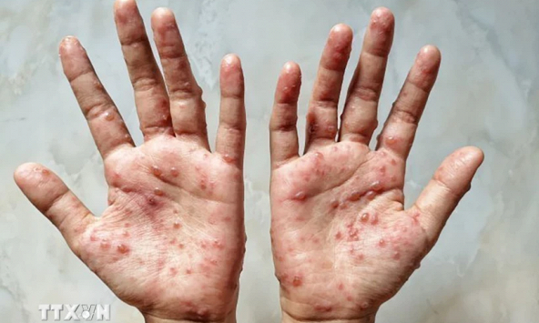 Phát hiện dạng đậu mùa khỉ mới dễ lây, có thể khiến 10% người bệnh tử vong