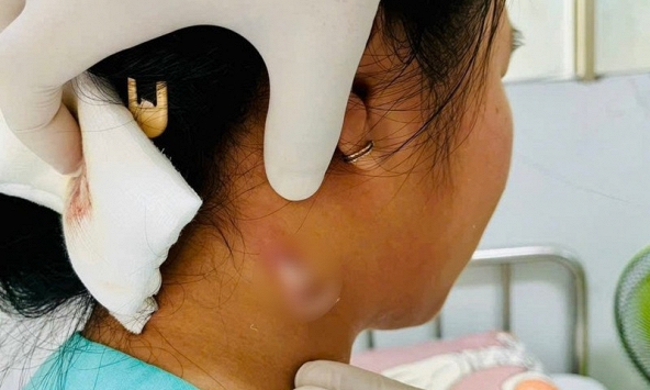 Vi khuẩn 'ăn thịt người' lây lan, phòng tránh như thế nào?