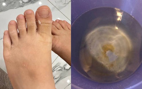 Nước sạch ở khu đô thị Thanh Hà gây mẩn ngứa: Chuyên gia nói về loại độc tố nguy hiểm đến sức khỏe