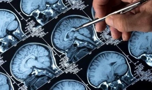 Tế bào gốc tự thân mở ra hy vọng mới trong điều trị nhồi máu não