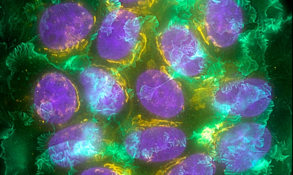 Ung thư giai đoạn 0 là gì? 