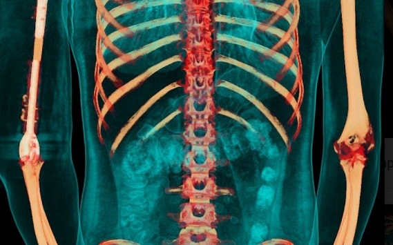 Lần đầu tiên trên thế giới, thay toàn bộ xương cánh tay “thiết kế riêng” sử dụng vật liệu siêu mới
