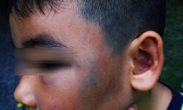 Phẫn nộ bé trai 8 tuổi bị đánh chảy máu mũi, phù nề vì nghi trộm gà