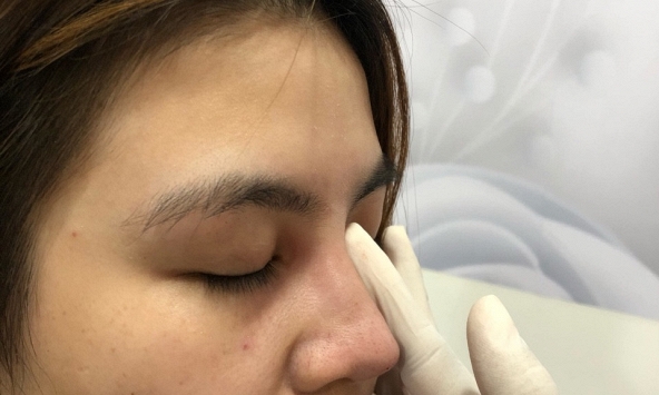 Khi phẫu thuật nâng mũi, cần phải lưu ý những gì?