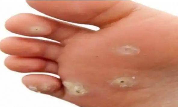 8 giải pháp tốt nhất để trị mụn cóc, bạn đã làm thử chưa?