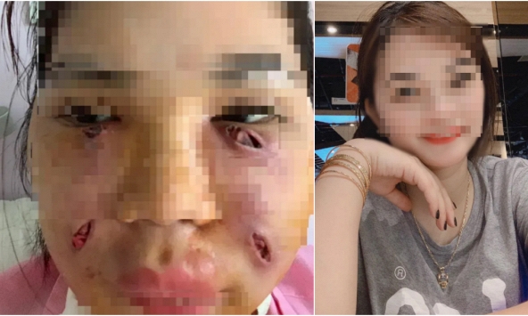 Cô gái xinh đẹp mặt biến dạng, chi chít lỗ mủ do tiêm mỡ tự thân làm đẹp