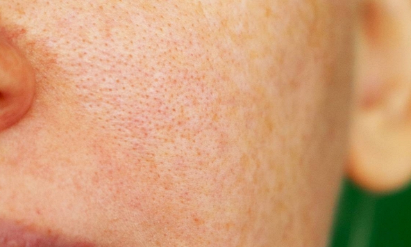 Lỗ chân lông như thế nào được gọi là bình thường?