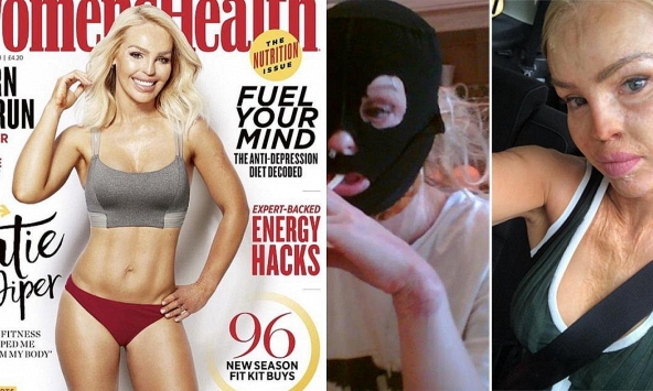 11 năm bước ra từ địa ngục của nữ người mẫu Anh bị bạn trai tạt axit