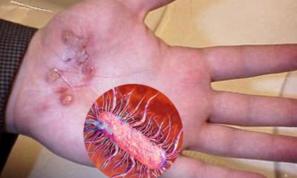 Bộ Y tế khuyến cáo người dân phòng tránh bệnh “vi khuẩn ăn thịt người”