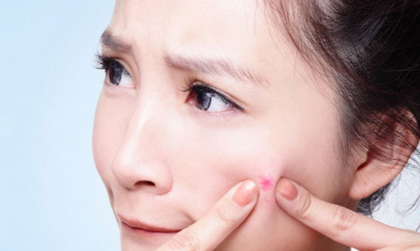 Mẹo chăm sóc da đúng cách sau khi nặn mụn