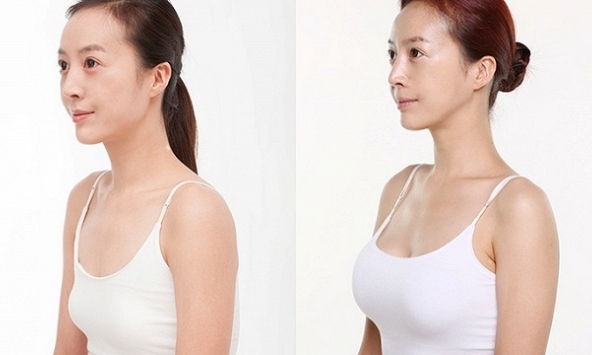 Những nguyên tắc để có một ca nâng ngực 'êm ả'