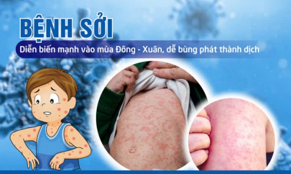 Thủ tướng ký ban hành Công điện yêu cầu tăng cường phòng, chống bệnh sởi