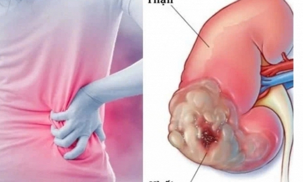 Ung thư thận: Nhận diện sớm để tăng cơ hội điều trị hiệu quả