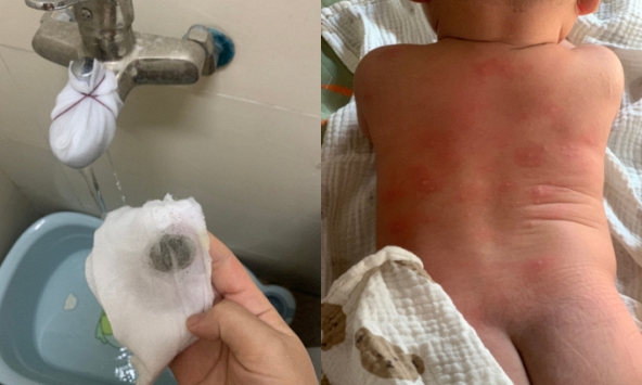 Sở Xây dựng Hà Nội lên tiếng vụ hàng trăm cư dân nổi mẩn ngứa, bong tróc da khi dùng nước sinh hoạt