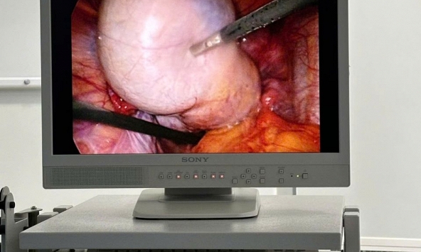 3 giờ “nghẹt thở” bóc tách khối u buồng trứng 10 cm cho bệnh nhân Gen Z tại Phú Quốc