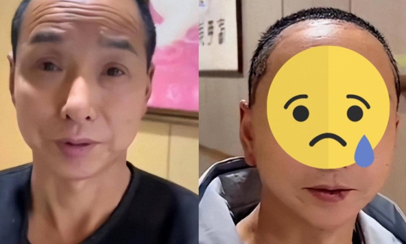 Người đàn ông “lột xác” sau phẫu thuật thẩm mỹ: Nhìn trẻ ra 30 tuổi nhưng ai cũng sợ khi thấy thứ này 