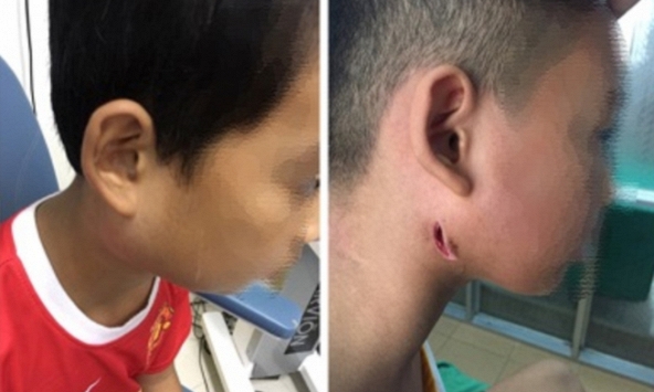 Báo động vi khuẩn ăn thịt người Whitmore đang gia tăng số bệnh nhân