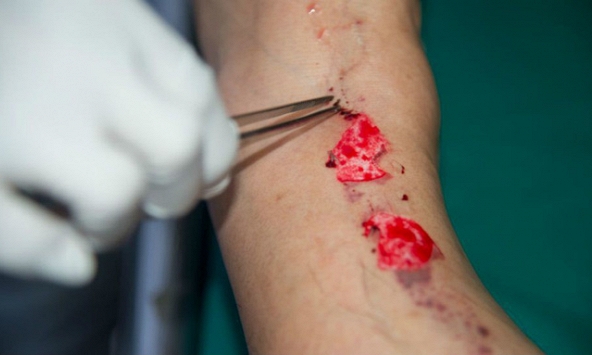 Bệnh 'vi khuẩn ăn thịt người' có lây không?