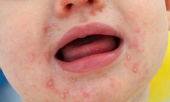 Bé bị tay, chân, miệng: khi nào cần nhập viện ngay?