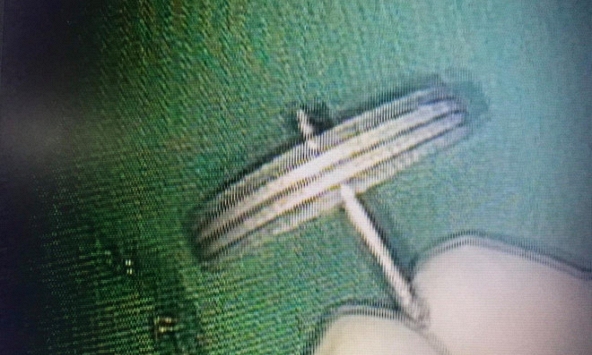 Nuốt bánh xe đồ chơi, bé trai 4 tuổi nhập viện cấp cứu  