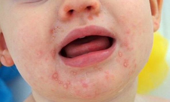 Trẻ bị tay chân miệng nhập viện tiếp tục tăng cao