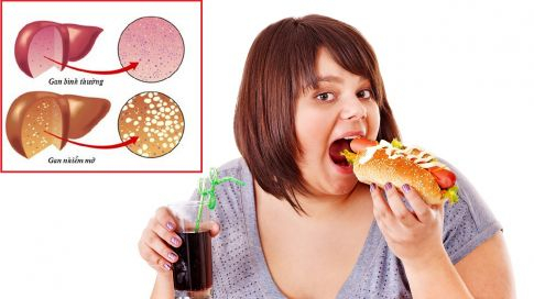 30 triệu người Việt mắc bệnh gan nhiễm mỡ