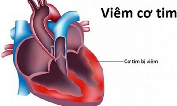 Thực hư virus viêm cơ tim gây chết người đang xôn xao cộng đồng mạng
