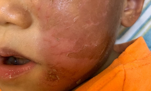 Đeo mặt nạ siêu nhân dịp Halloween, da mặt bé trai bị bỏng rộp