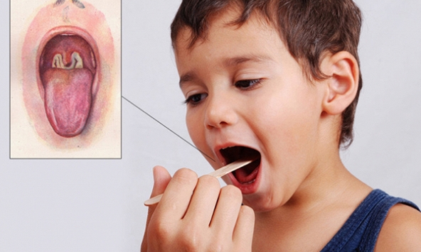  Bệnh bạch hầu làm 2 người tử vong nguy hiểm thế nào?