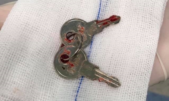 Bắt chước ảo thuật gia, bé trai nuốt chùm chìa khóa