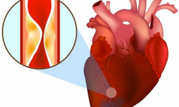 Cảnh báo cho người dưới 35 tuổi: Nhồi máu cơ tim ngày càng trẻ hóa