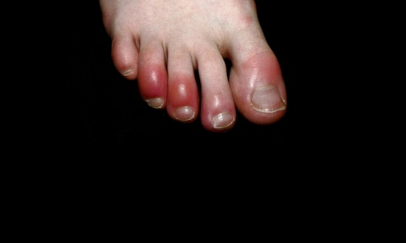 Hiện tượng 'ngón chân Covid-19' tăng đột biến