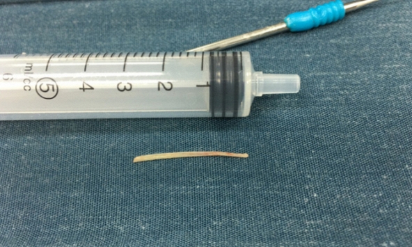 Bé gái suýt mất mạng vì hóc xương cá 5 tháng, trị bằng mẹo dân gian