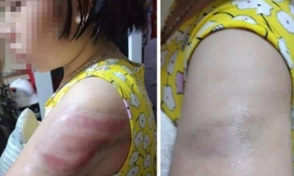 Vụ học sinh bị đánh bầm tím tay vì viết bài chậm: Cô giáo tường trình do mất bình tĩnh