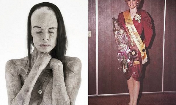 Hành trình tái sinh của Hoa hậu bị bỏng 85% cơ thể: 'Tôi sống trong làn da ấy'