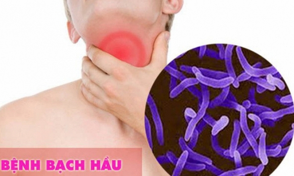 Bé trai mắc bệnh bạch hầu ở Gia Lai đã tử vong