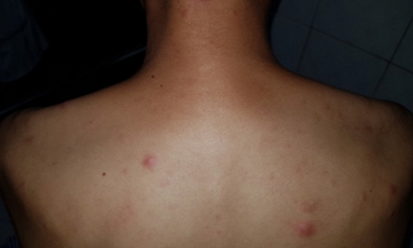 Tái xuất hiện bệnh phong cùi