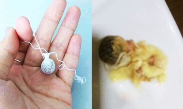 Chuyên gia nói gì về loại 'kén' được quảng cáo chữa tất cả các bệnh phụ khoa?