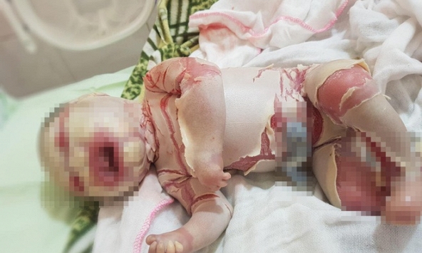 Bé sơ sinh mắc bệnh lạ với lớp vảy trắng bọc toàn thân kèm theo những vết nứt sâu, chảy máu