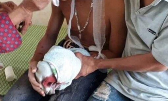 Máy tính xách tay phát nổ, 3 học sinh nát tay và bị thương vùng mặt