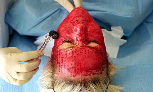 Nhiều nguy cơ tiềm ẩn từ phương pháp “cải lão hoàn đồng” cho làn da bằng máu tự thân 