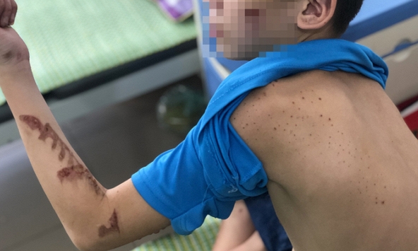 Cậu bé 14 tuổi bị chủ quán bánh xèo ở Bắc Ninh bạo hành dã man