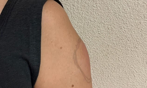 ‘Cánh tay COVID’ – tác dụng phụ hiếm gặp sau tiêm vaccine COVID-19