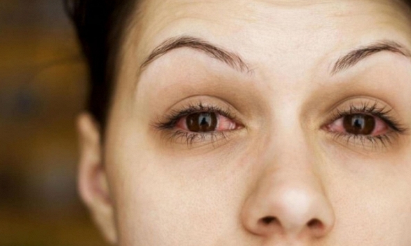 Một số bệnh nhân Covid-19 nặng gặp biến chứng nguy hiểm trên mắt có thể gây mù lòa