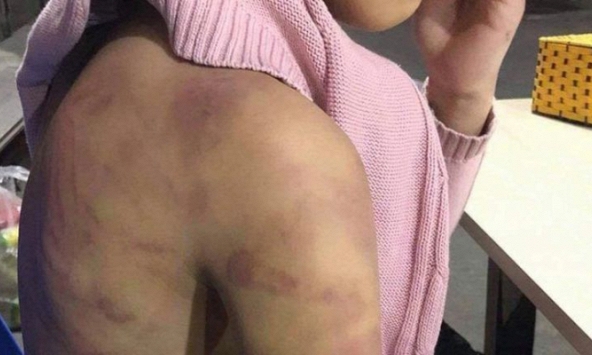 Nghi án bé gái 12 tuổi bị mẹ ruột và người tình bạo hành dã man